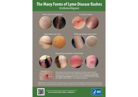 Lyme Disease and People of Color